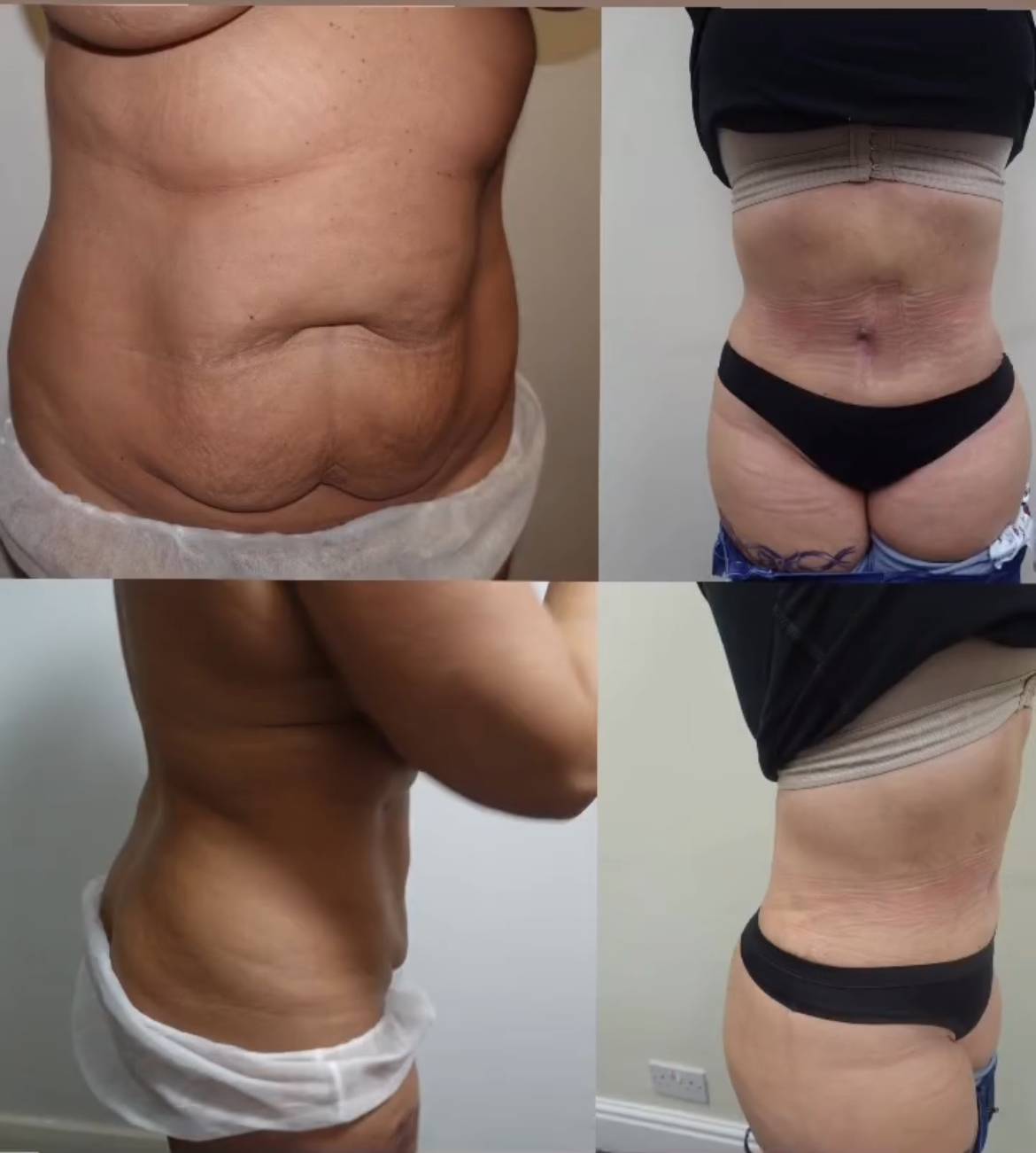 60D10E86-D824-4213-8FED-1FA45C66D440_1_201_a a dr Frati tummy tuck before and after
