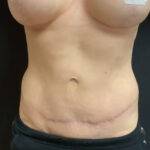 mummy makeover results