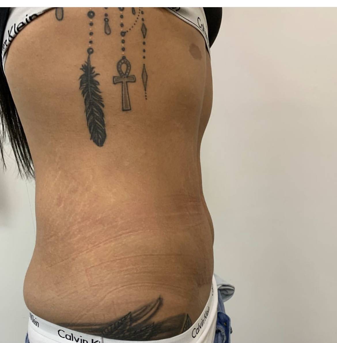 8289F994-6E6A-47F7-A155-CA2727847E32_1_201_a tummy tuck before and after by Frati