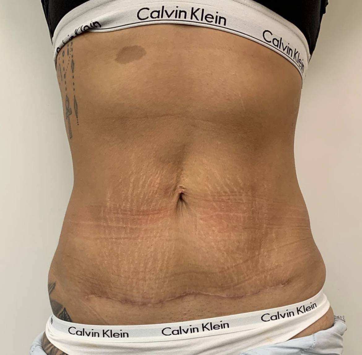 IMG_2255 tummy tuck before and after by dr Frati