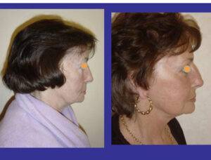 facelift before and after