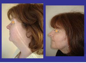 facelift before and after