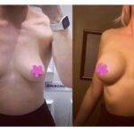 boob job before and after
