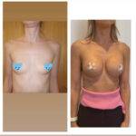 boob job before and after