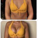 boob job before and after yellow biniki