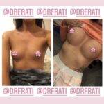 dr frati boob god designing boob job before and after image