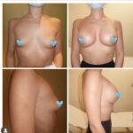 boob job before and after