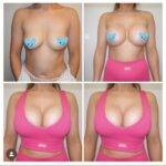 boob job before and after