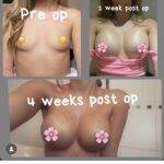 boob job before and after