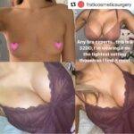 boob job before and after