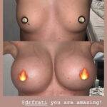 boob job before and after