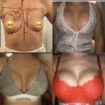 boob job before and after