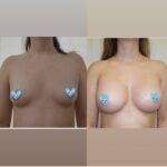 boob job before and after