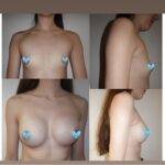 boob job before and after