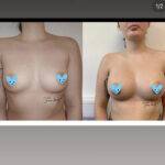 boob job before and after