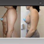 boob job before and after