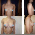 boob job before and after