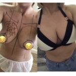 boob job before and after