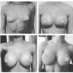 boob job before and after 4 images