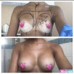 boob job before and after 2 images