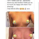 boob job before and after review