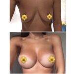 boob job before and after