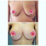 boob job before and after