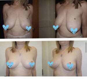 breast lift before and after a few images