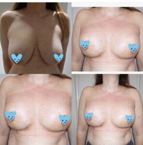 breast life before and after on a women