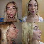 four images of a woman with a nose job before and after