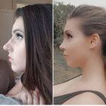 nose job before and after