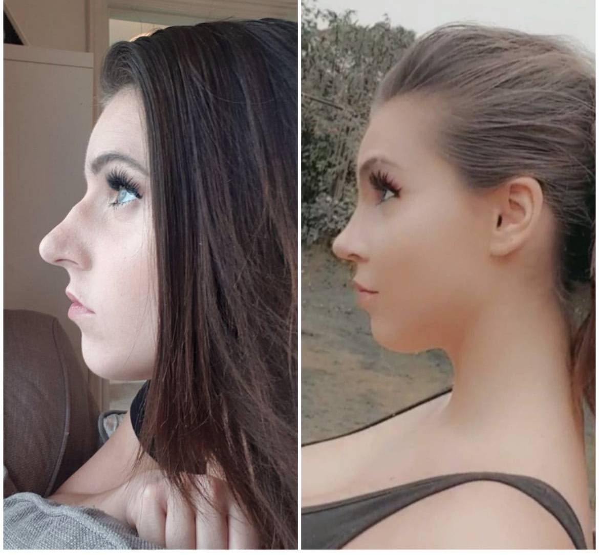 nose job before and after