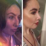 nose job before and after 2 pictures septorhinoplasty procedure