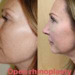 nose job before and after open op