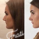 nose job before and after on a woman