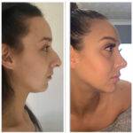 a woman demonstrating a nose job before and after with a septorhinoplasty procedure