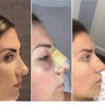3 photos of a nose job before and after