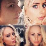 4 photos of a nose job before and after