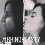 open nose job before and after