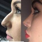 nose job before and after