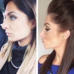 nose job before and after on a young woman