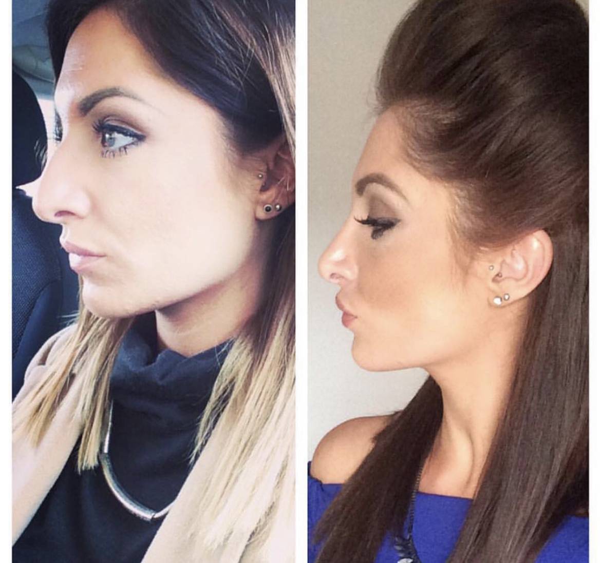 nose job before and after on a young woman