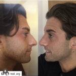 celebrity nose job before and after non surgical rhinoplasty by the best rhinoplasty surgeon London and manchester