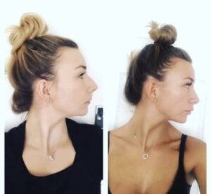 nose job before and after