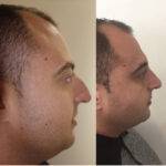 nose job before and after on a man