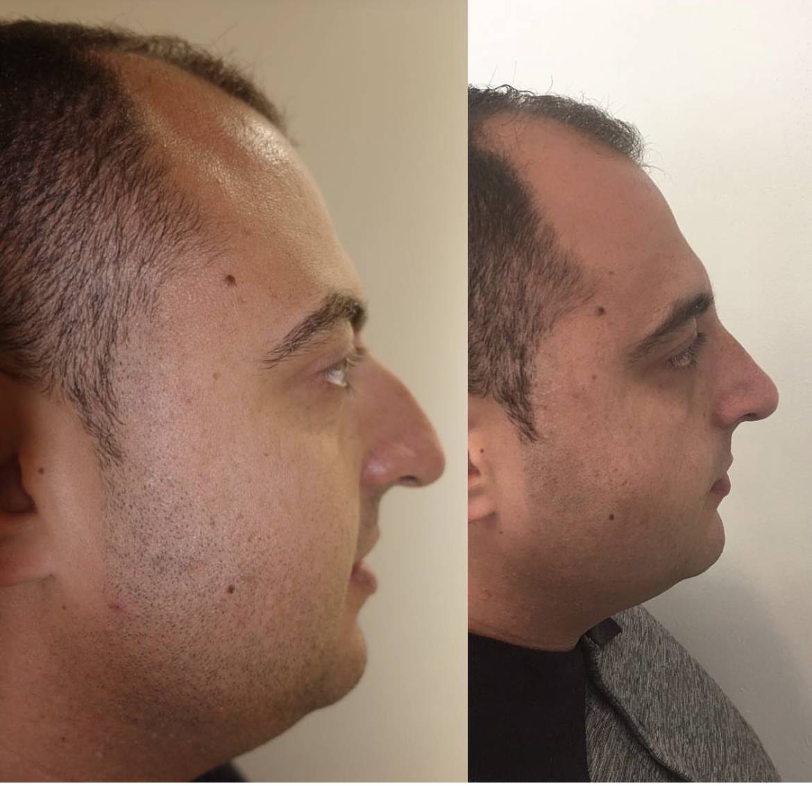nose job before and after on a man