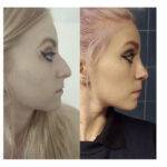 nose job before and after on a lady