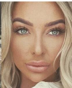 open rhinoplasty result